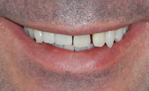 Veneers before