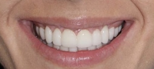 Veneers after 1